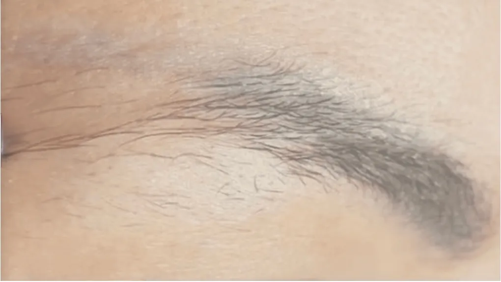 Eyebrow PMU after removal