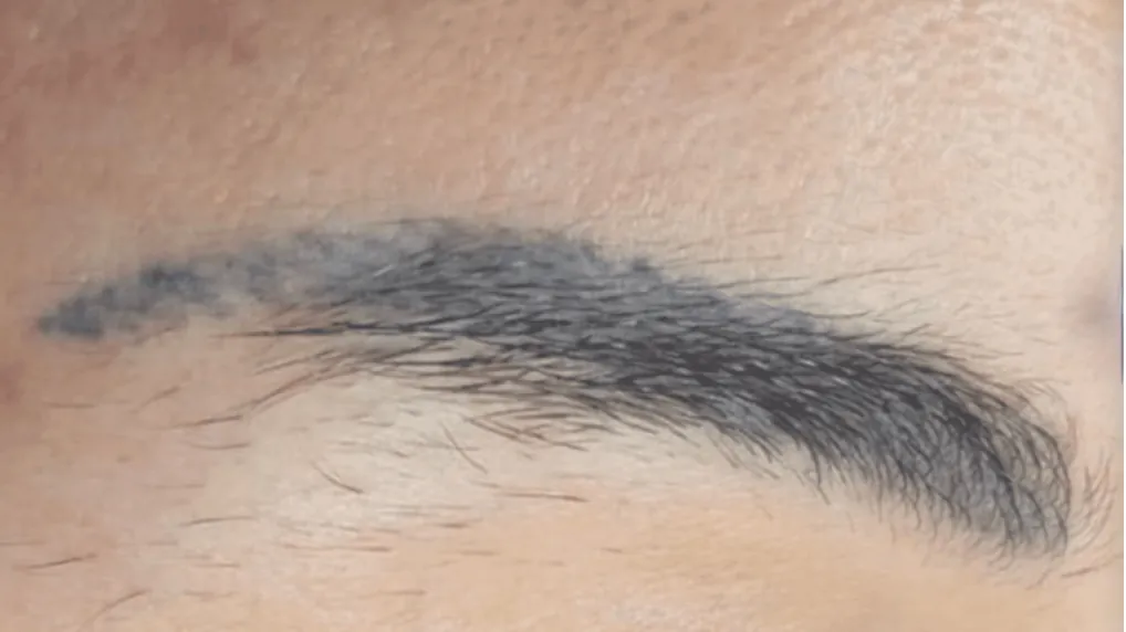Eyebrow PMU before removal