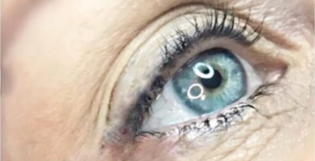 Permanent eyeliner after removal
