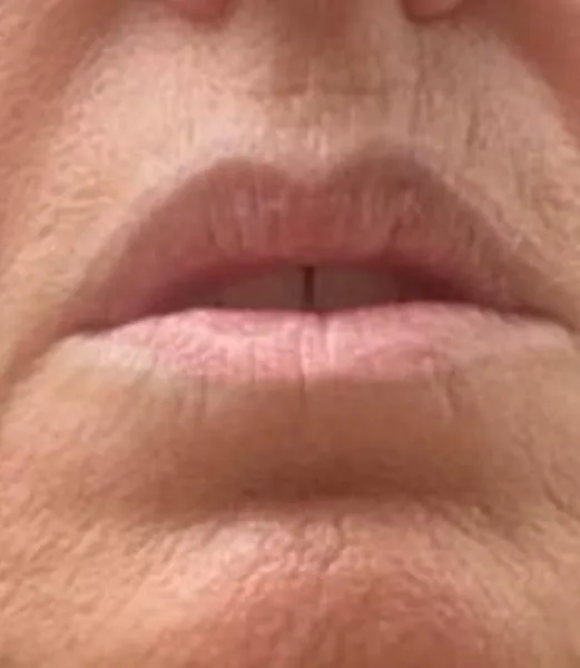 Lip liner after removal