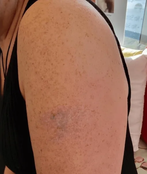 Medium body tattoo after treatment