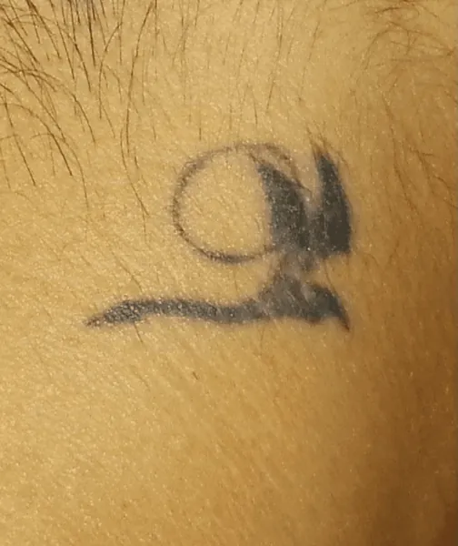 Body tattoo before treatment